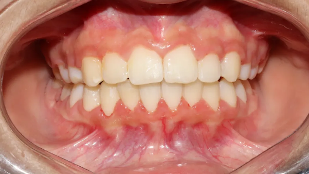 What si the right age to get braces ?