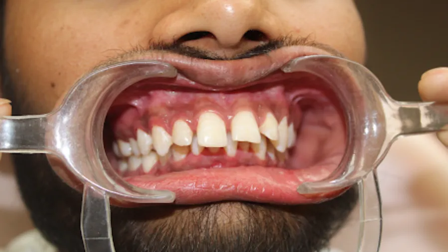 Why is Braces Treatment So Important for Your Health & Confidence?