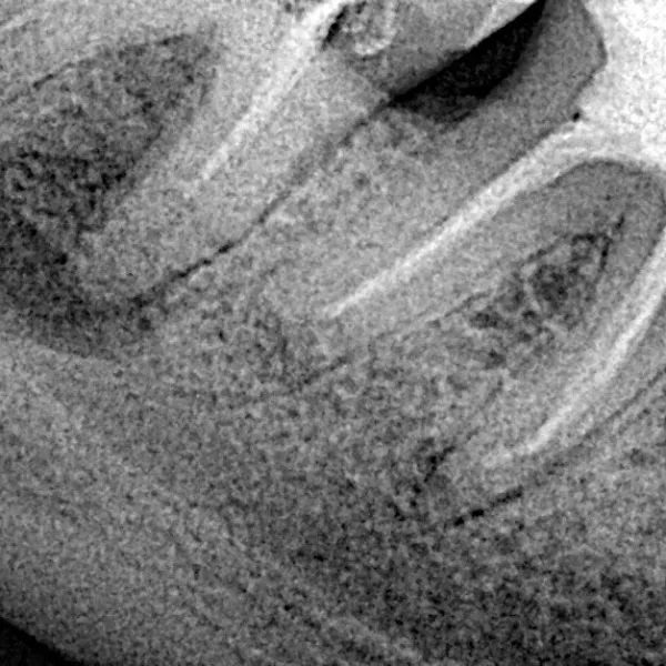 Clinical Case Study: Surgical Extraction of an Infected Wisdom Tooth with Root Resorption
