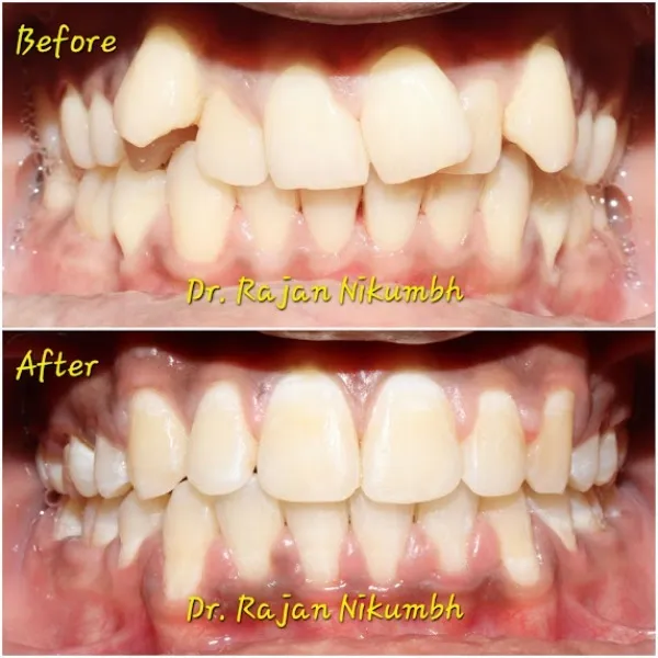 Have you ever wondered if you can mix and match your braces? Absolutely! At Dr. Rajan Nikumbh Dental...
