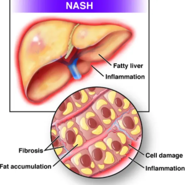 Non Alcoholic Steatohepatitis Treatment Starts With Understanding the Disease