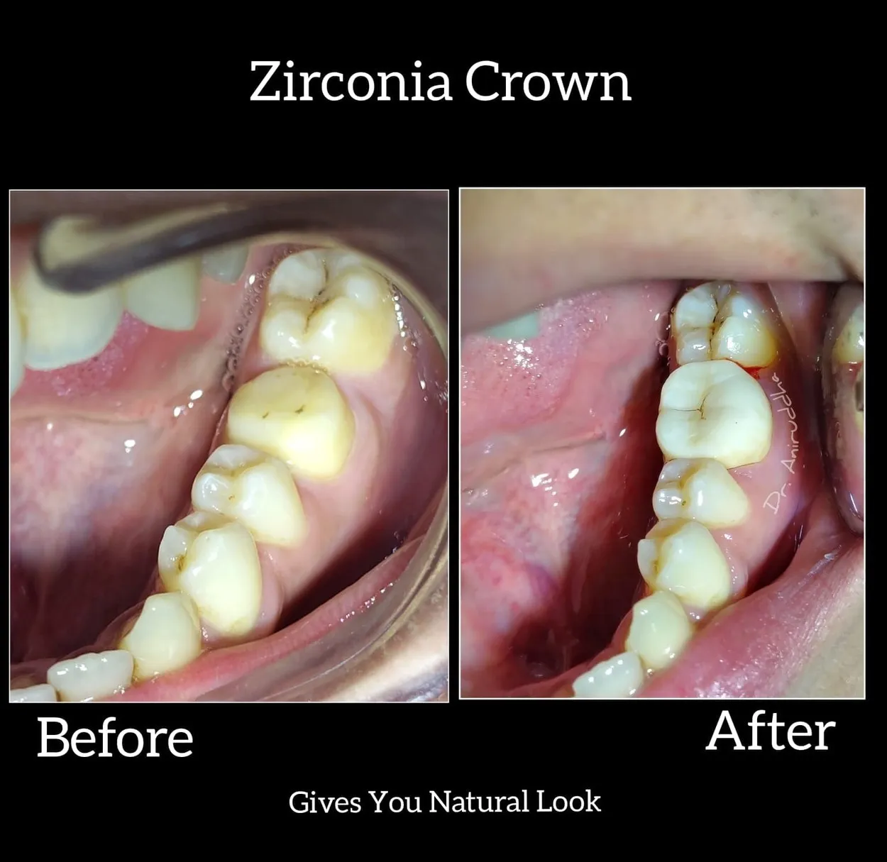 Zirconia Crown (Metal Free Cap) Dental Cap Tooth Cap