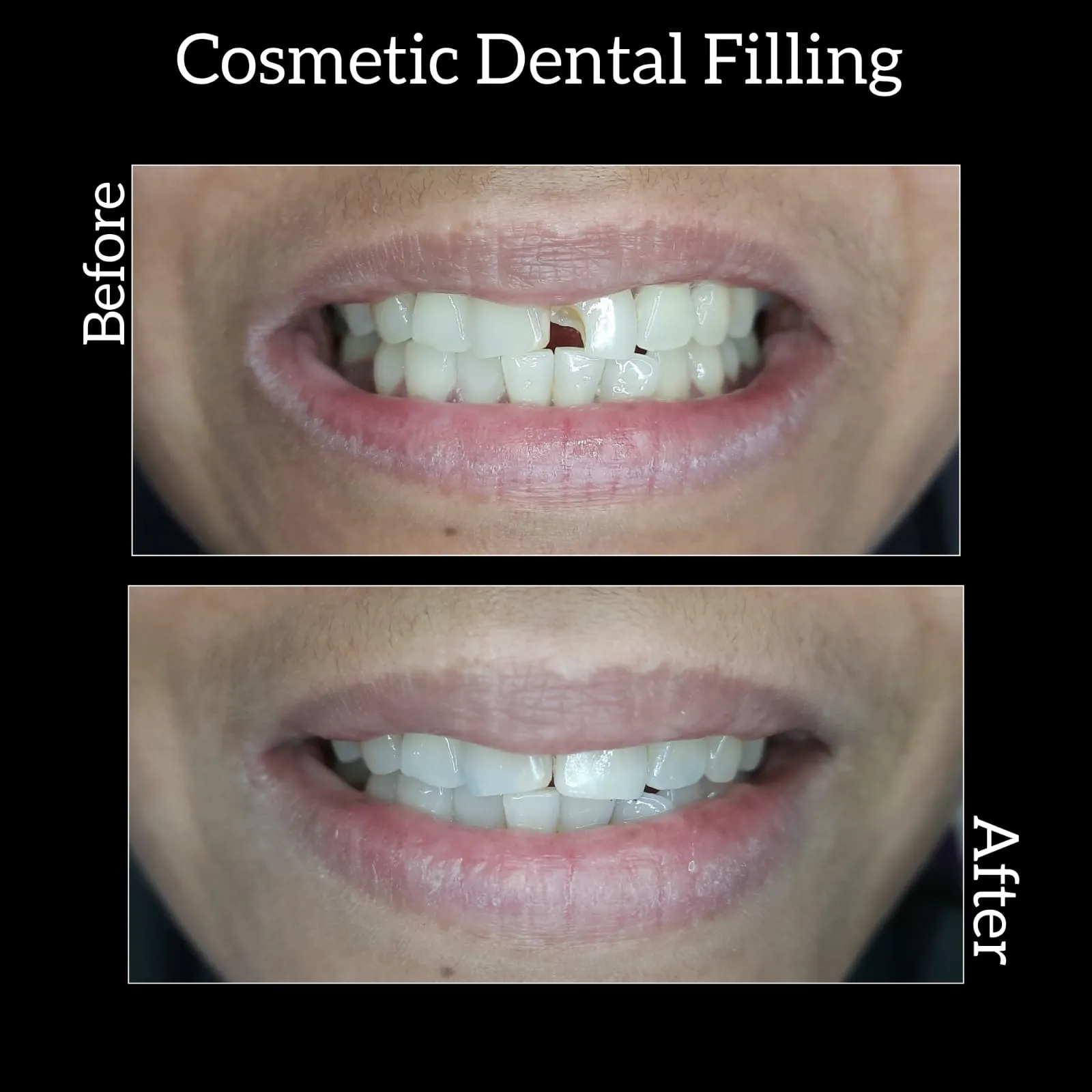 Aesthetic / Cosmetic Dental Fillings/ Composite Bonding/Tooth Coloured Filling/ Teeth Gap Closure