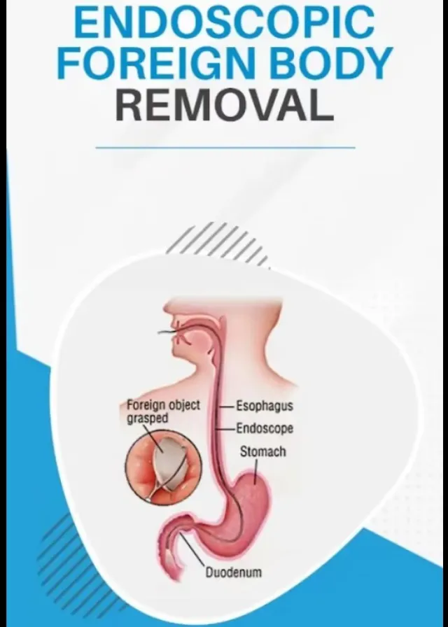 Endoscopic Foreign Body Removal and When It May Be Needed
