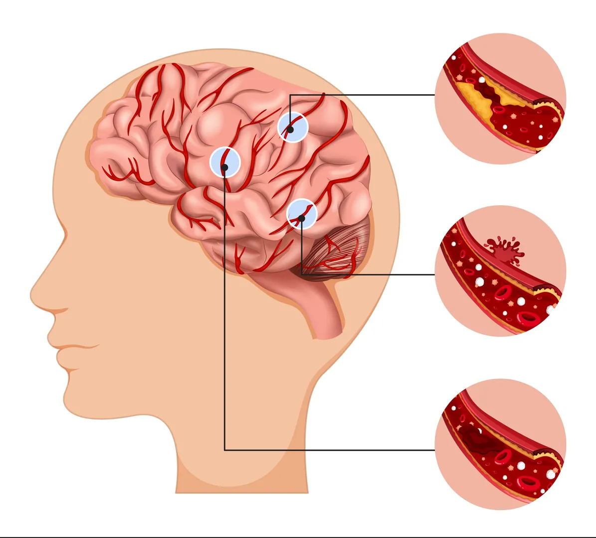 Stroke and Aneurysm: Understanding the Difference and When Specialist Care Is Needed in Bandra