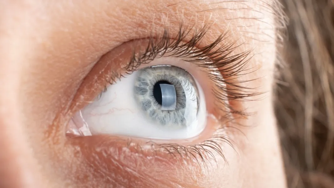 Cornea Treatment Can Protect Vision When the Eye's Clear Surface Is Damaged