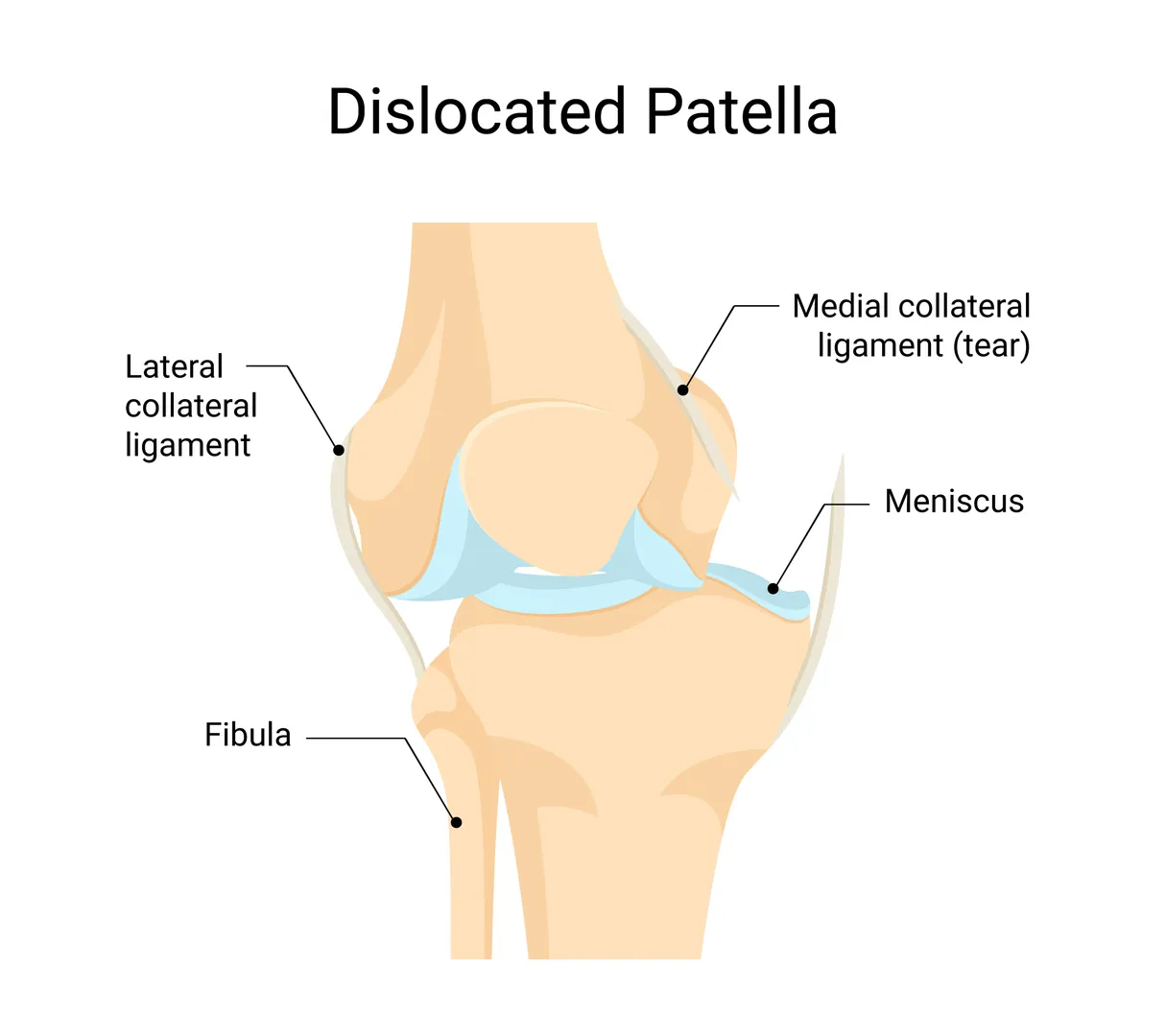 What Patients Should Know About Patella Dislocation Surgeries for an Unstable Kneecap