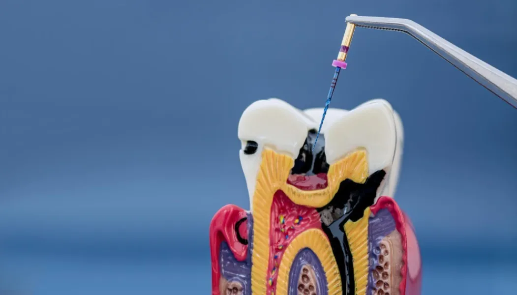 When Is Root Canal Treatment Necessary Understanding the Early Warning Signs