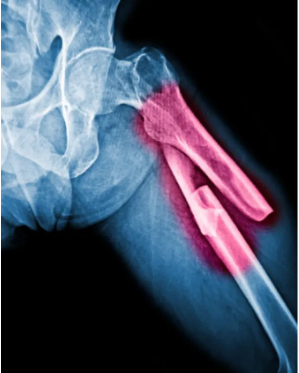Understanding Pathological Fractures: When a Broken Bone May Signal an Underlying Disease