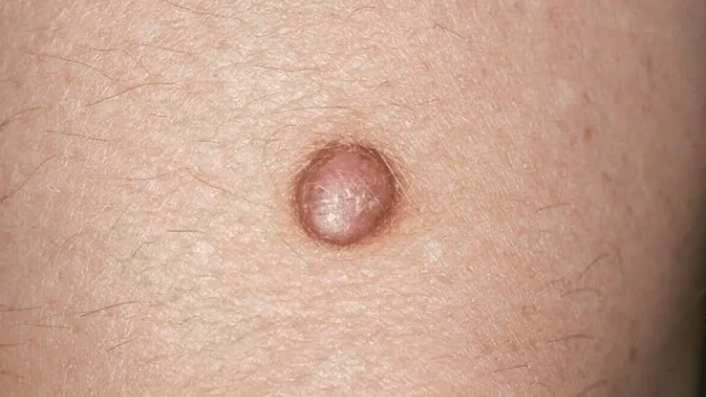 Removal of Dermatofibroma or any small skin tumour at Rakesh Reddy's Skin Clinic located in Sanjay N