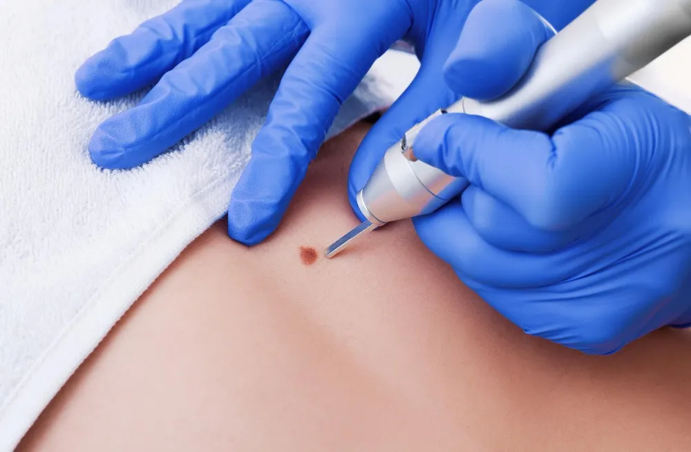 When Should You Consider a Mole Removal Treatment Clinic in Sanghvi?