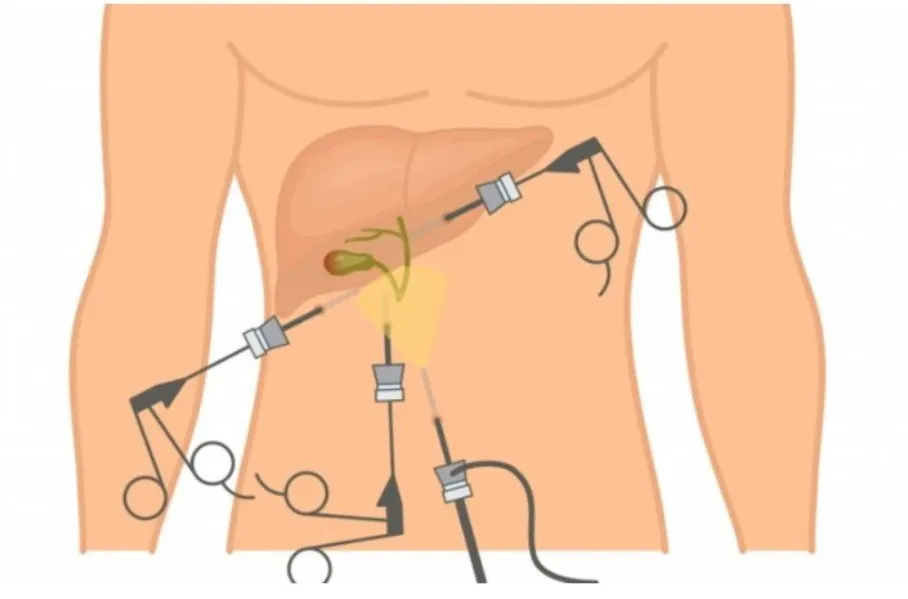 Gallbladder Stone Surgery in Thane: When Is Surgery Needed?