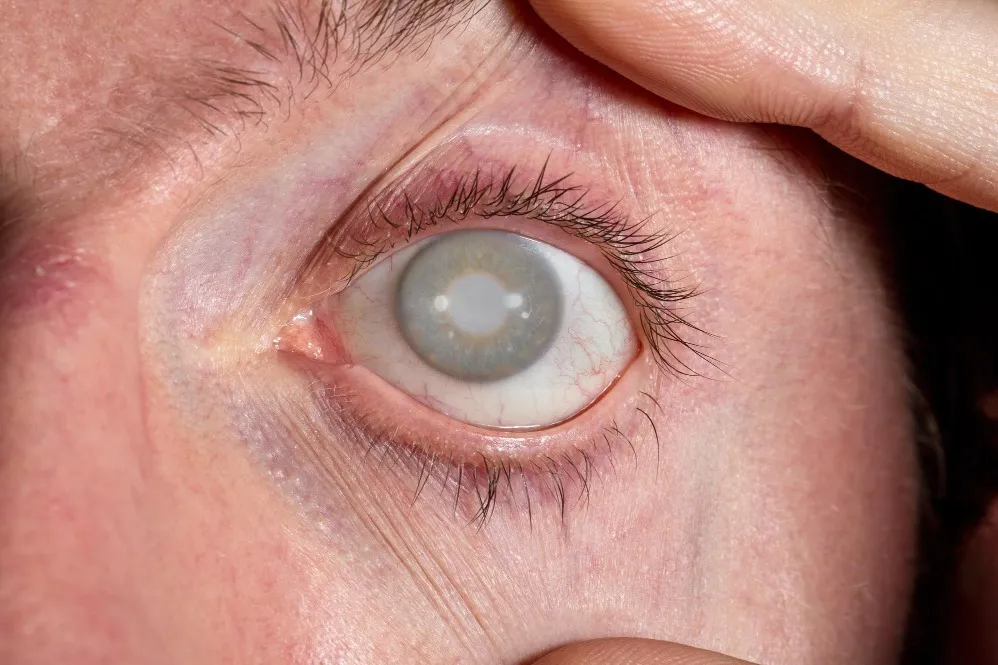 Glaucoma Treatment Begins with Early Detection Before Vision Loss Occurs