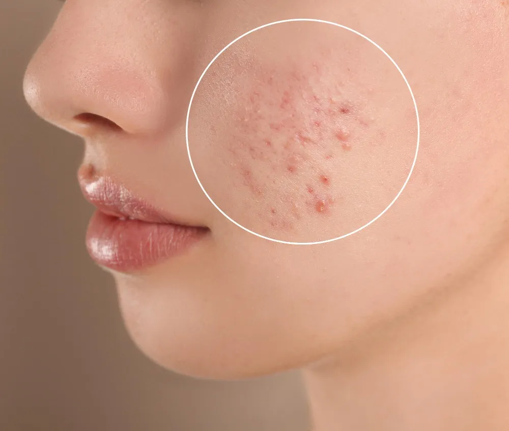 When Should You See a Dermatologist for Acne Scar Removal in Chennai?