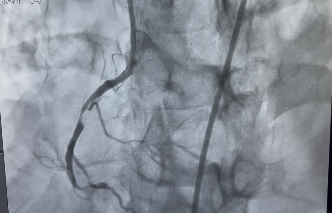 Complex Angioplasty: Advanced Treatment for Difficult Coronary Blockages