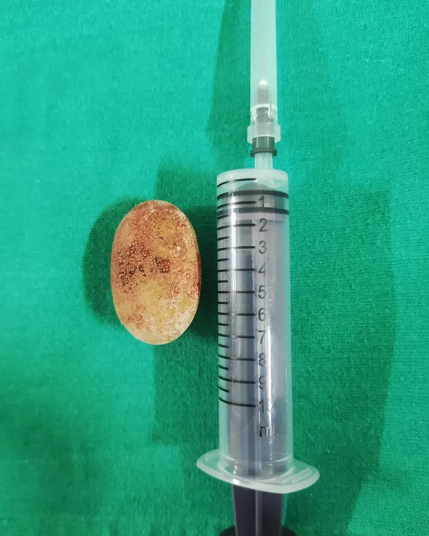 Bladder stone(Vesical calculus)