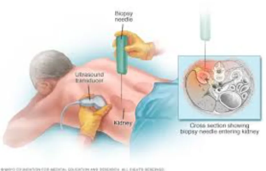 Kidney Biopsy: Why It Is Done, What It Can Diagnose and What Patients Can Expect