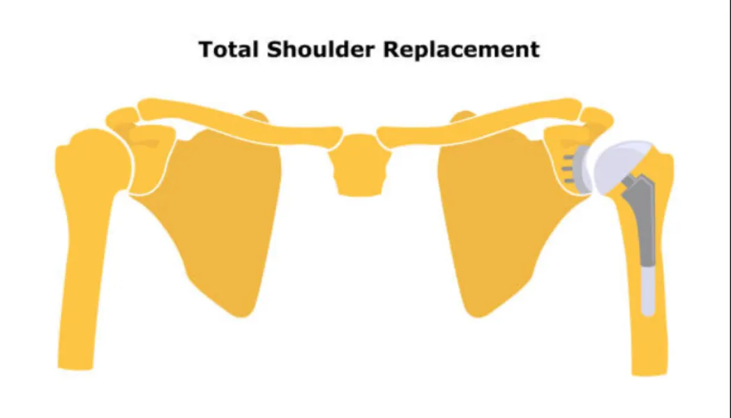 Total Shoulder Replacement in Santacruz, Khar and Bandra for Severe Shoulder Joint Damage