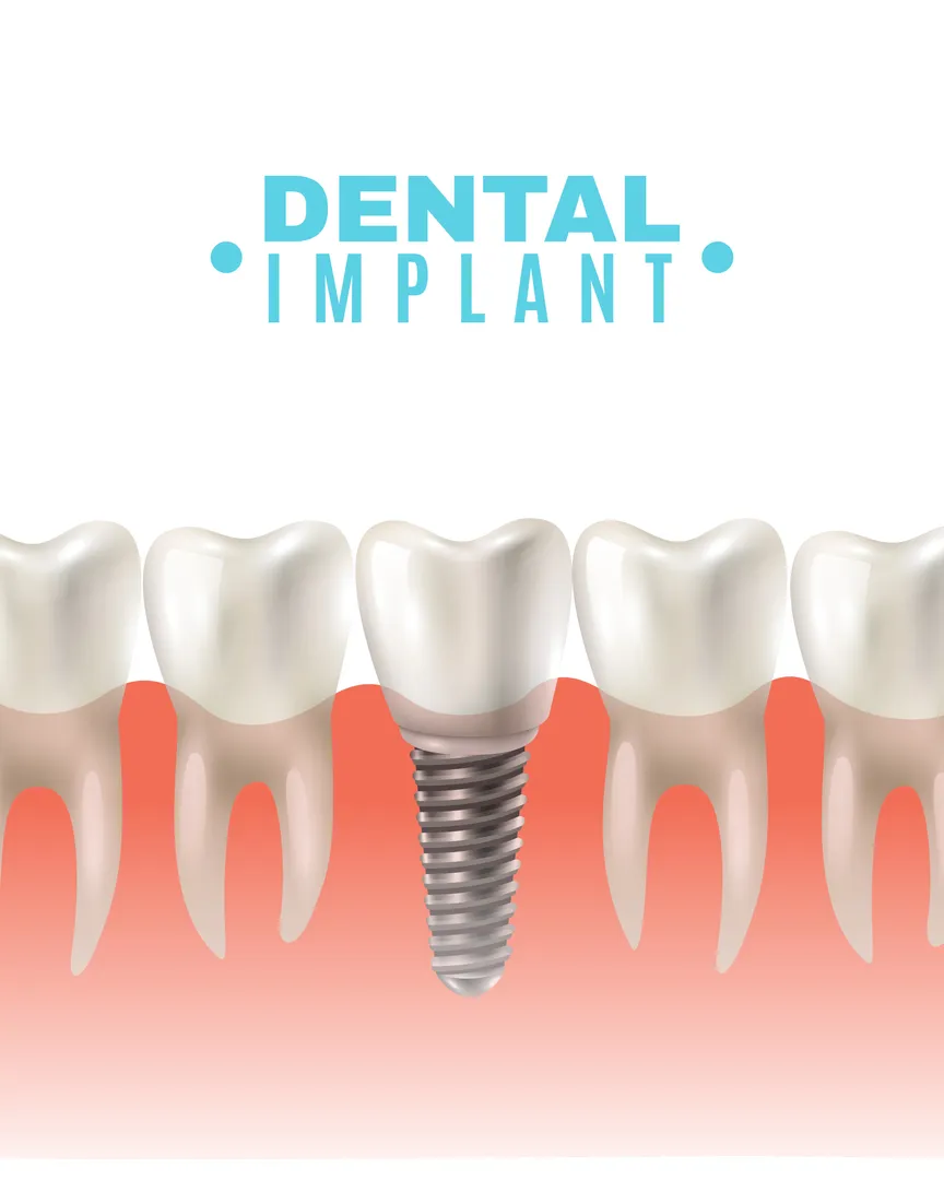 Dental Implant Cost in Mumbai: How to Compare Complete Treatment Plans