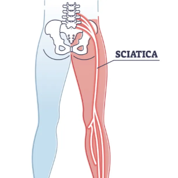 Understanding Sciatica Through Early Symptoms Before Pain Becomes Severe