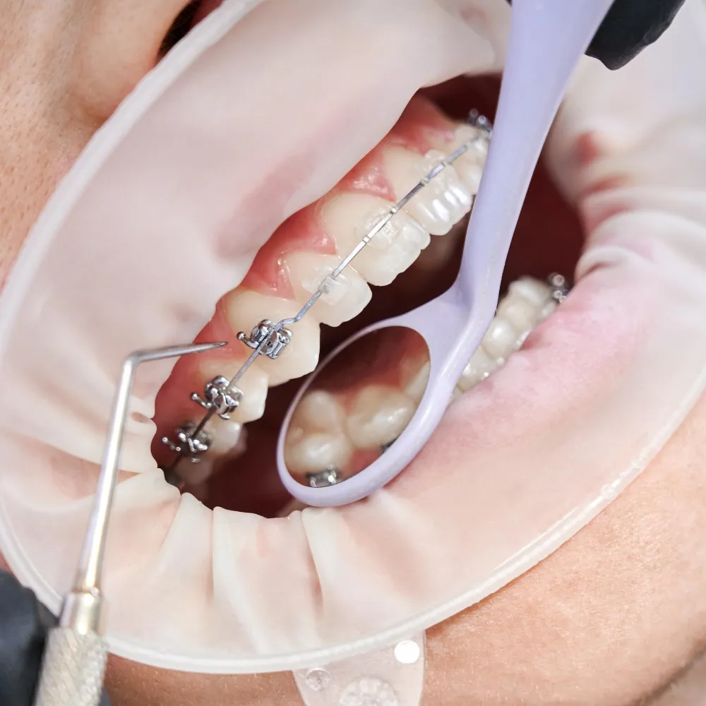 Removable Braces and Fixed Braces in Thane Compared