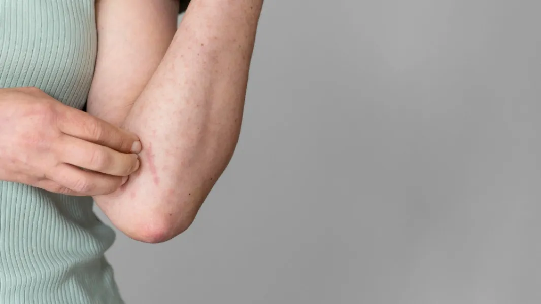 Searching for a Skin Allergy Doctor Near Me? Here's What to Look For