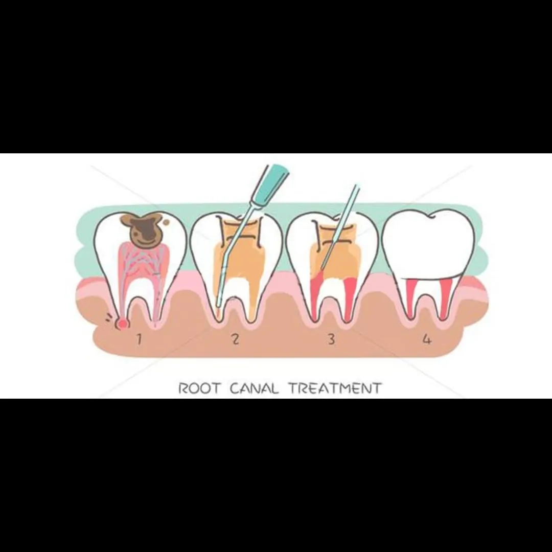 Re Root canal Treatment In Vashi