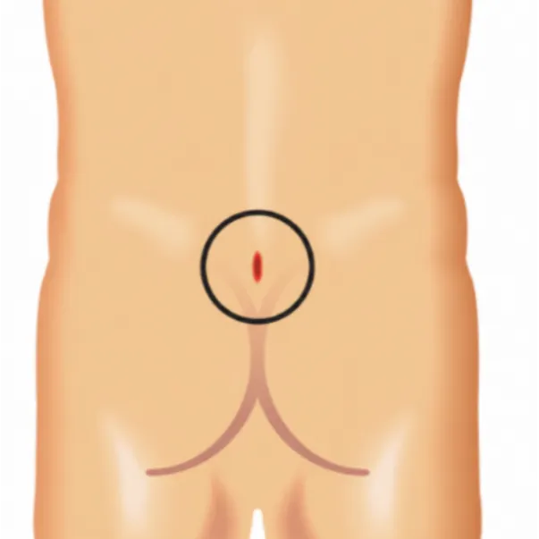 Pilonidal Sinus Treatment Early Care Can Help Prevent Recurring Infections