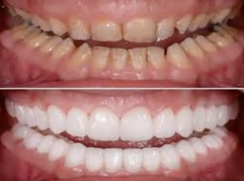 How Full Mouth Rehabilitation Rebuilds Function Across Multiple Dental Problems