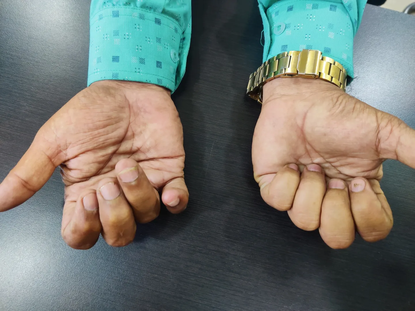 Complex Regional Pain Syndrome (CRPS): What It Is and How to Recognise the Early Warning Signs