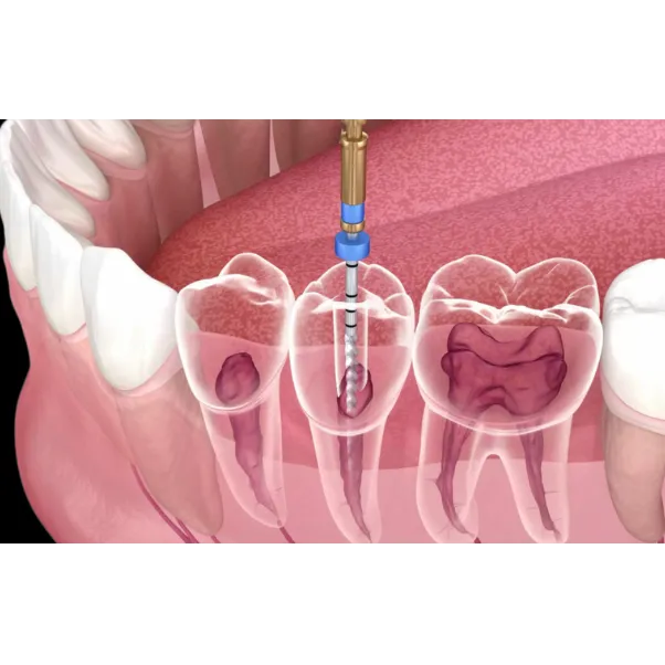 Painless Root Canal Treatment in Mulund West – Comfortable Dental Care for Your Tooth