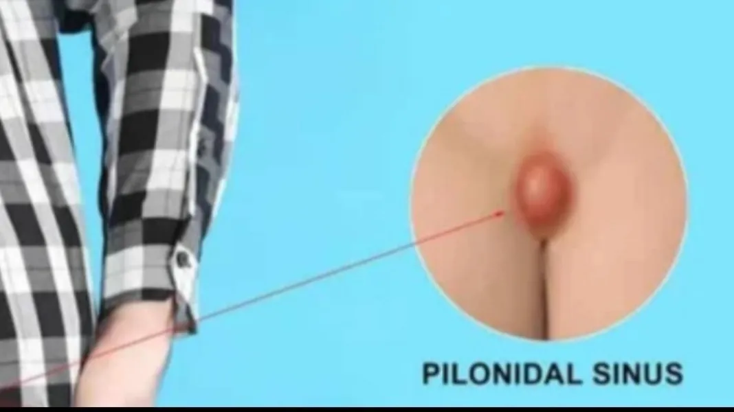 Pilonidal Sinus Laser Surgery in Malad: When Is Surgery the Best Option?