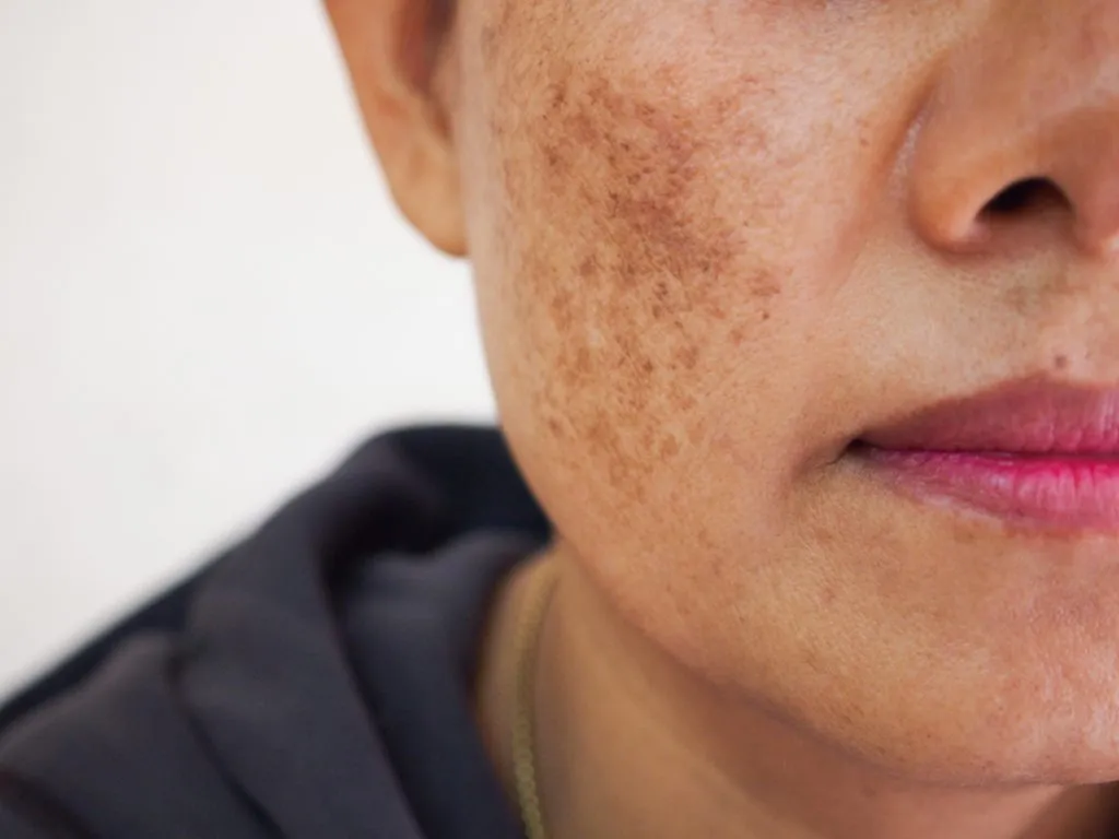 Best Skin Pigmentation Treatment in Delhi