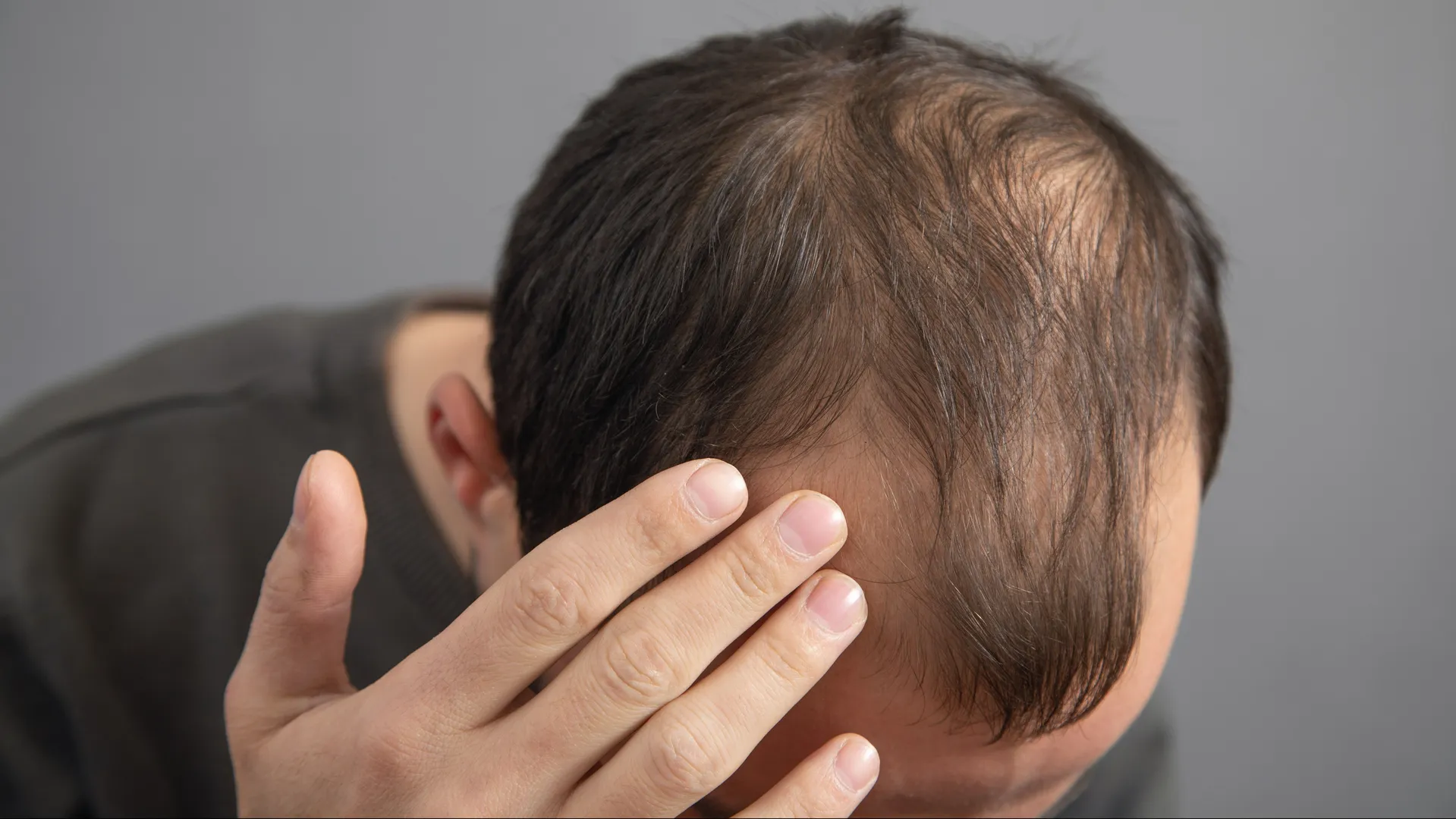 Best Hair Loss Treatment in Delhi
