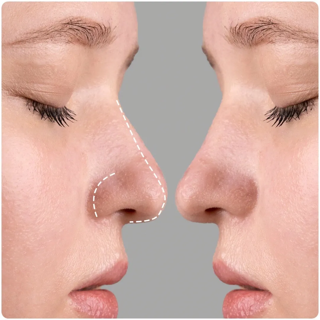 Best Rhinoplasty in Delhi