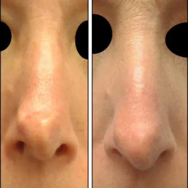 Best Nose Reshaping in Delhi