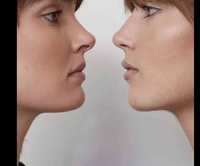 Best Nose Job in Delhi