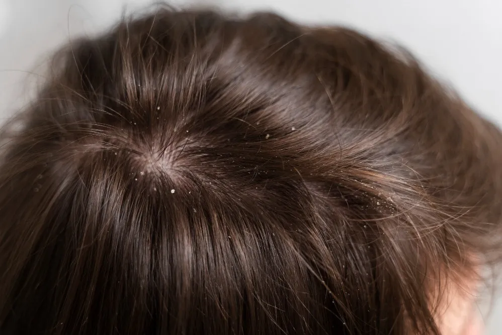 Common Dandruff Treatment Mistakes That Can Keep Scalp Flaking Active