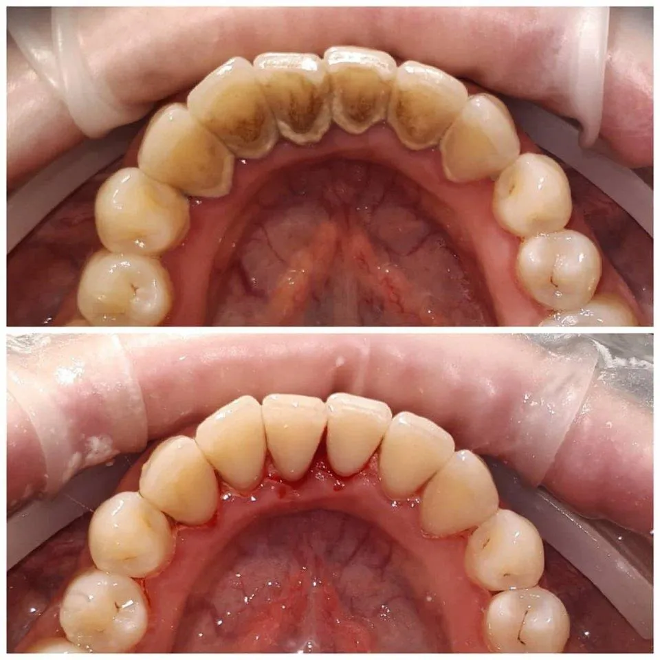 Professional Teeth Cleaning: Benefits, Procedure & How Often You Need It