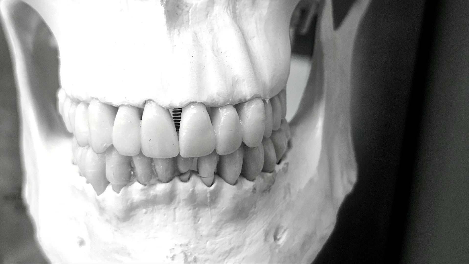 Affordable Full Mouth Implants Near Me In Colaba Mumbai