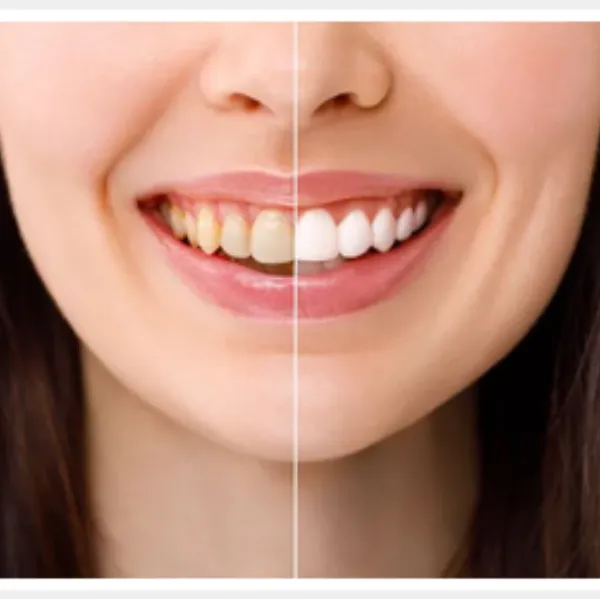 Teeth Whitening – Professional Teeth Whitening in Mulund West