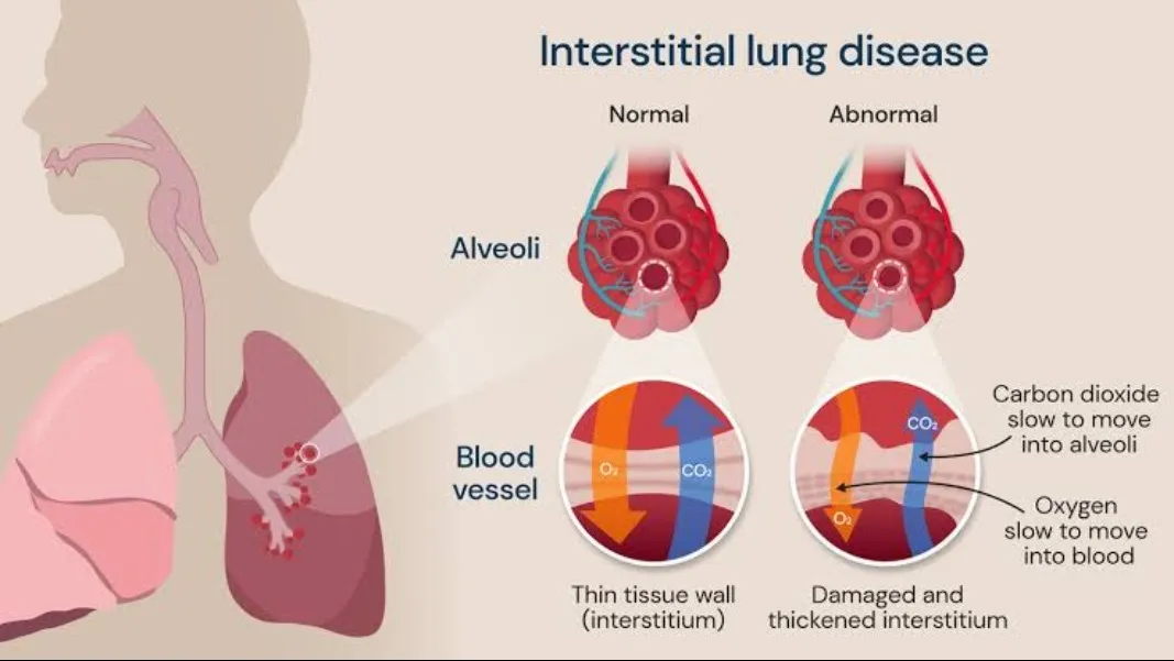 Bronchoscopy Treatment