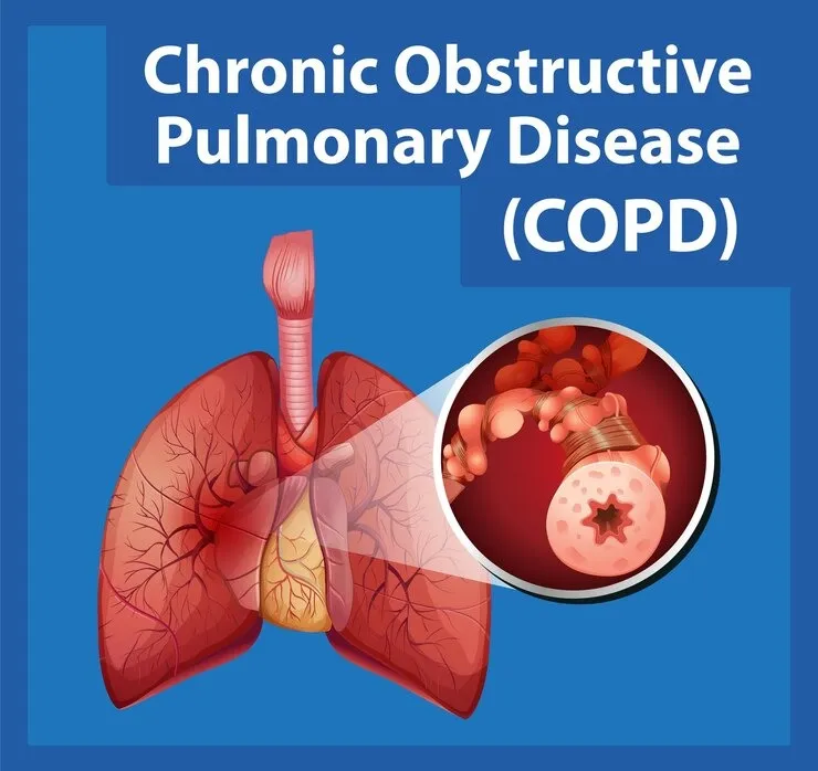 COPD Treatment