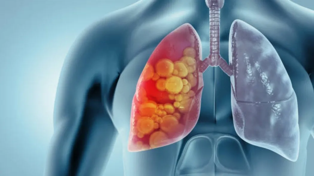 Lung Cancer Treatment