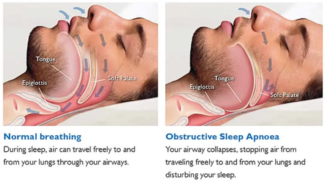 Sleep-Disordered Breathing