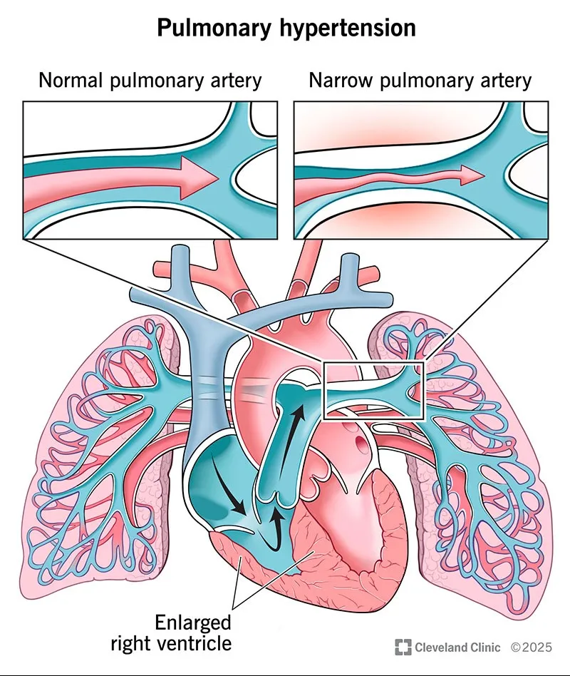 Pulmonary Hypertension Tretments
