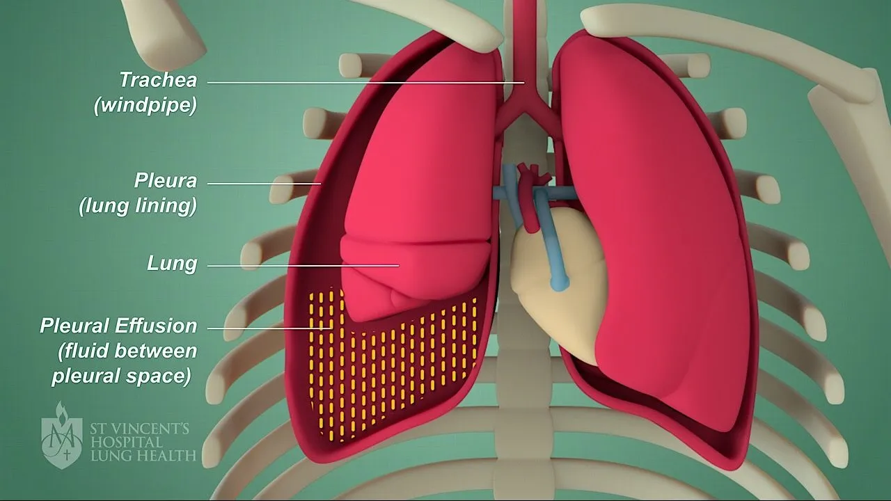 Pleural Disease Treatment – Dr. Sanjay Gabhale