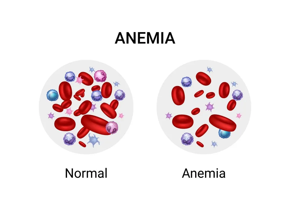 Understanding Aplastic Anemia Treatment for Children and When Early Care Matters