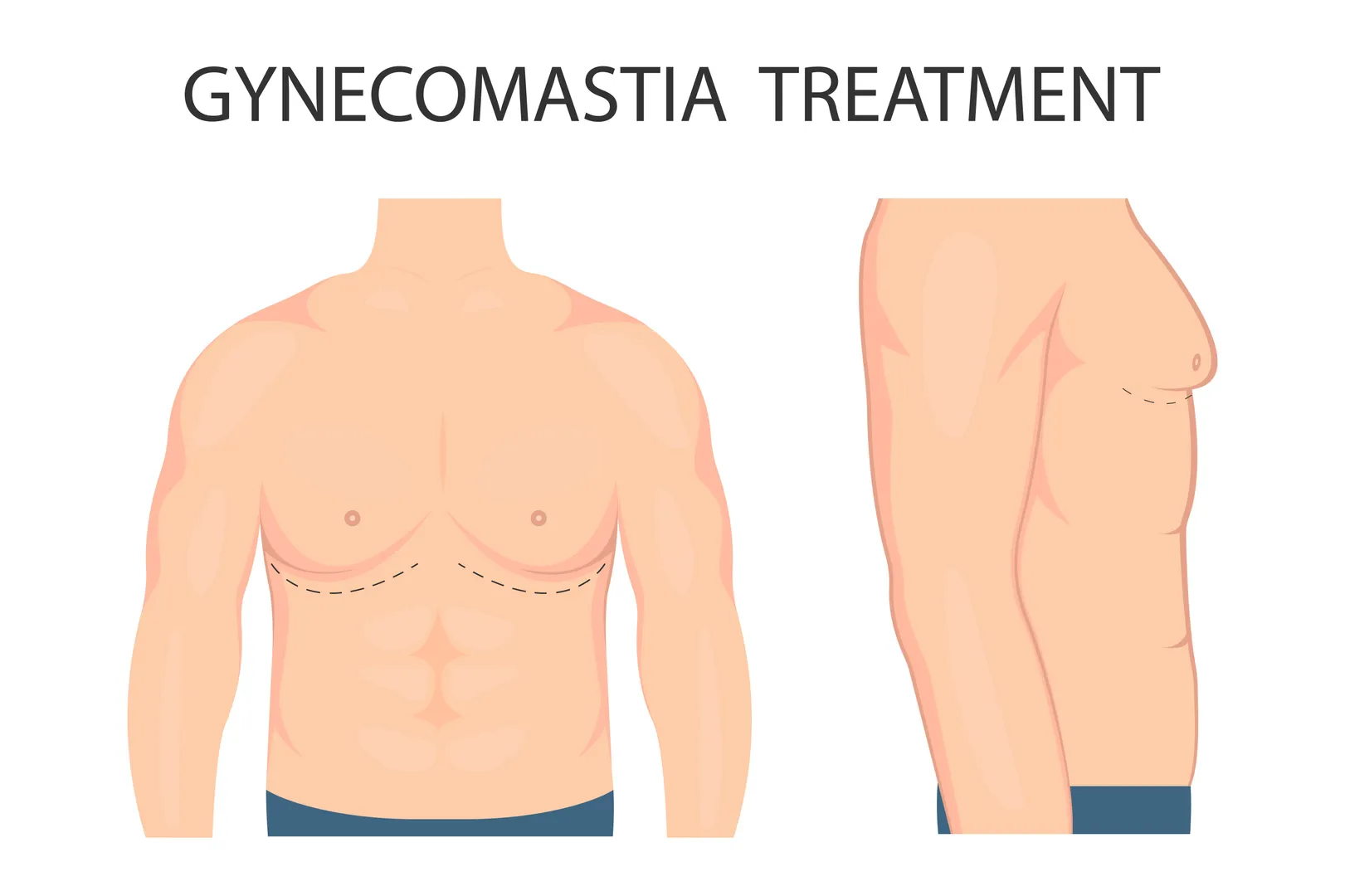 When Gynecomastia Surgery Becomes the Right Choice
