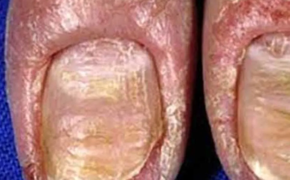 Treatment of Nail infections at Rakesh Reddy's Skin Clinic conveniently located at Sanjay Nagar, Heb